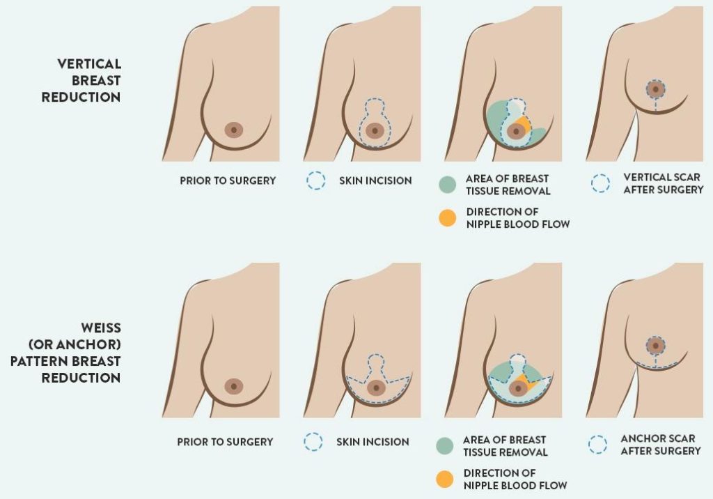 breast reduction