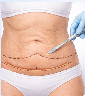 tummy tuck procedure