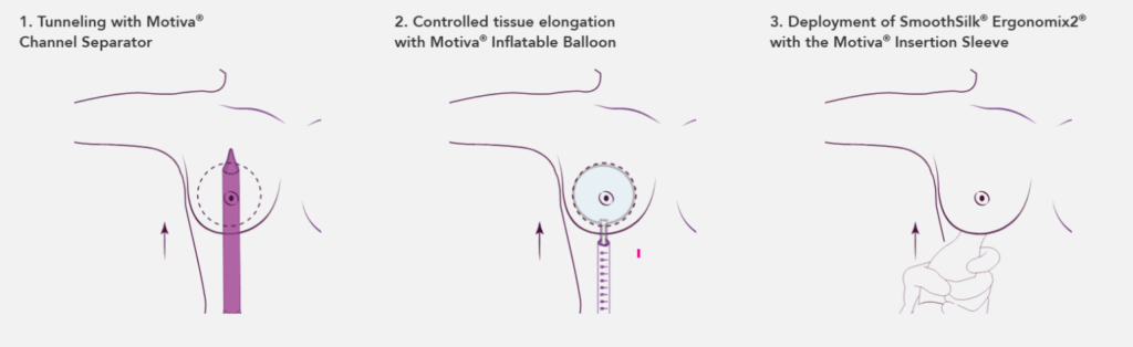 preserve motiva procedure