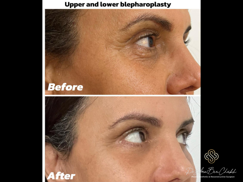 dr salma bf af upper and lower belpharoplasty