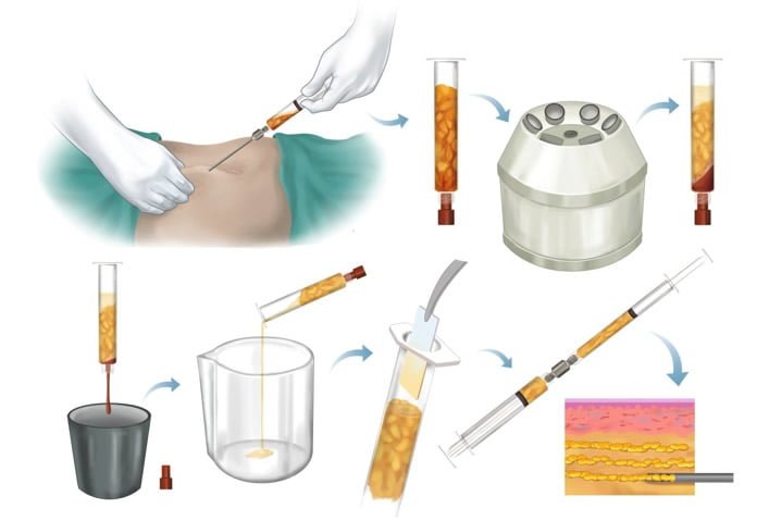 nanofat procedure