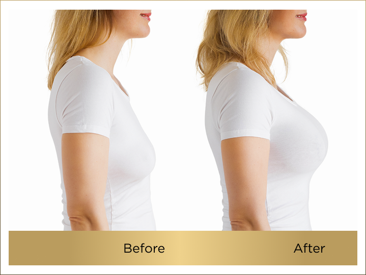 breast implant cost