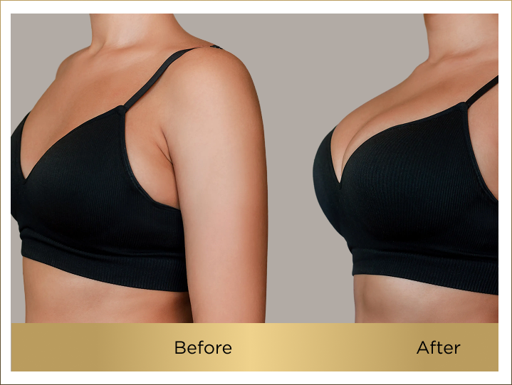 breast implant price