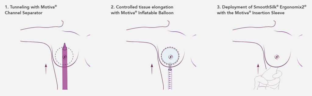preserve breast augmentation procedure