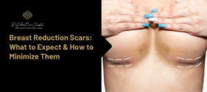 breast reduction scars