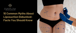 liposuction myths